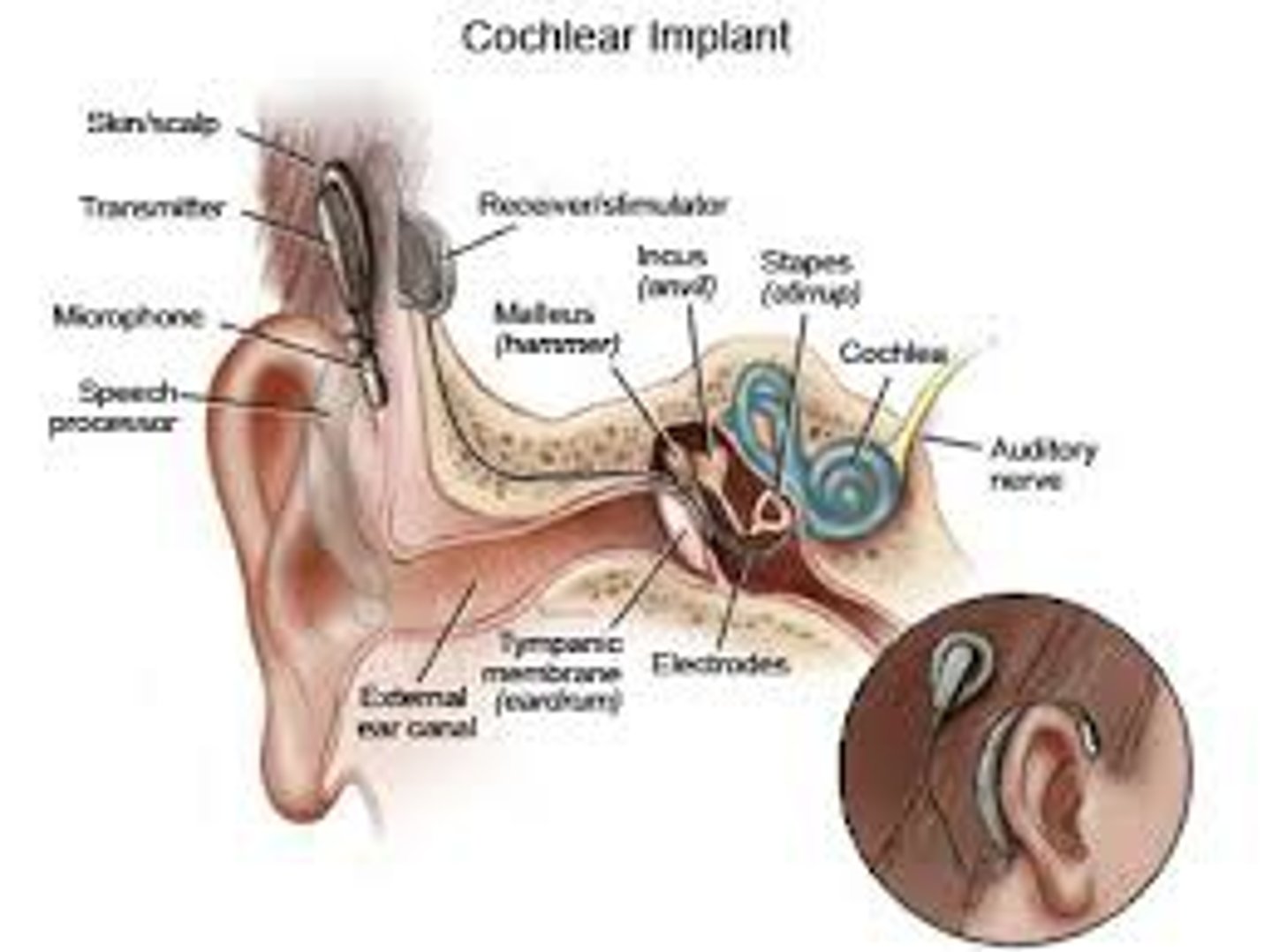 <p>uses electrodes that are surgically implanted in the cochlea, which are stimulated by signals they are sent by a connected outer device placed behind the ear (s).</p>