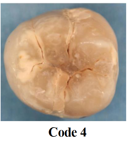 <p>Underlying shadowing from dentin with or without enamel breakdown</p>