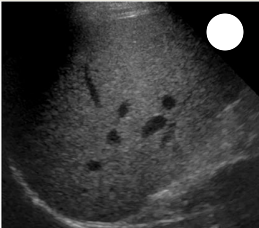 <p>how would you grade this liver for fatty infiltration</p>