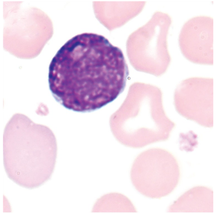 <p>what is a lymphoblast?</p>