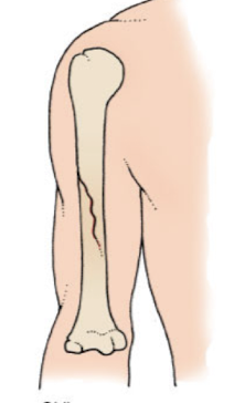 <p>A fracture that occurs at an angle across the bone, typically due to a sharp angle of force</p>