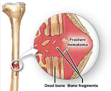 <p>Fracture Hematoma Formation</p>