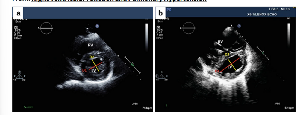<p>RV/LV interdependence-Eccentricity index. </p><p>(a) Normal right and left ventricular morphology: the left ventricle has a round configuration; the ratio of the antero-posterior dimension (D1) to the septal-lateral dimension (D2) is close to </p><p>1. (b) Right ventricular overload, the LV takes a crescentshape, the interventricular septum flattens, and antero-posterior dimension of the left ventricle is greaterthan the septal-lateral</p>
