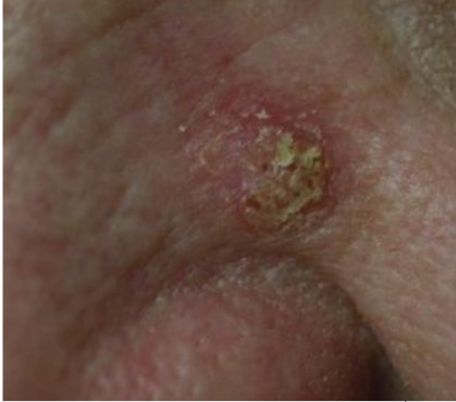 <p>Superficial Basal Cell Carcinoma </p><ul><li><p>pink patch, often w/ focal scaling (localized, distinct area of dry, flaking skin cells)</p></li><li><p>will NOT heal</p></li></ul><p>MIMIC: Actinic Keratosis (precursor SCC) & SCC in Situ</p><ul><li><p>due to keratotic scaling of SCC</p></li></ul><p></p>