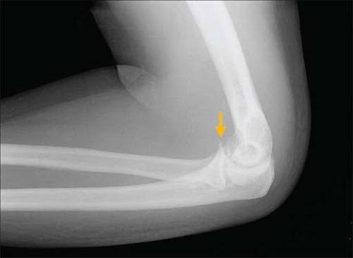 Coronoid Process Fracture | Journal of Orthopaedic & Sports Physical Therapy
