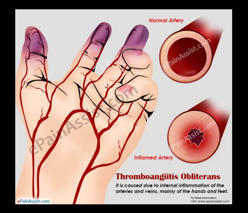 <p>Begins at palmar arch, spreads centrally up arm</p>