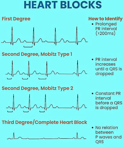 <p>Mobitz II second degree AV block</p><p><sub>(</sub><em><sub>note: this may progress to a 3rd degree block as it usually indicates structural problem (ischemia/fibrosis))</sub></em></p><p><sub>±pacemaker</sub></p>