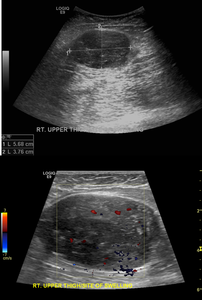 <p>IVC thrombus</p>