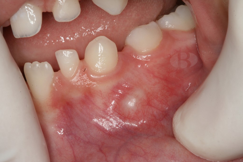 <p><span><span>Retardo en la erupción dental y generalmente asintomático.</span></span></p>