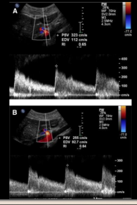 <p>A young women mimics signs and symptoms usally exacerbated with expiration, and has a “hook” like appearance on 2D whats is the pt diagnosis and explain what this picture tells you?</p>
