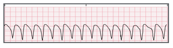 <p>Identify the above waveform:</p><p>a. SVT or atrial tachycardia</p><p>b. VTACH</p><p>c. PAC</p><p>d. AFIB</p>