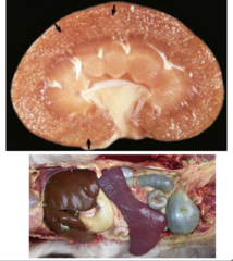 <p>What disorder affecting the renal corpuscles is this gross image showing with lightly swollen, slightly pale kidneys and pinpoint foci on the cut surface?</p>