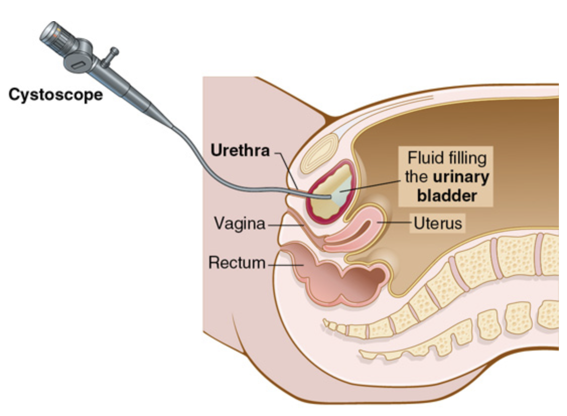 <p>Instrument to visually examine the urinary bladder</p><p>: 방광을 눈으로 관찰하는 기구, 방광경</p><p>*A cystoscope is placed through the urethra into the urinary bladder during cystoscopy.</p><p>*방광경 검사 중 방광경을 요도를 통해 방광 안으로 삽입합니다.<br><br><strong>Female urinary tract. </strong><br>A cystoscope is placed into the urinary bladder through the urethra. Notice the position of the uterus and vagina between the bladder and the rectum.<br><br>The medical diagram depicts a female pelvic section with a cystoscope inserted into the urinary bladder through the urethra. The urinary bladder is partially filled with fluid, outlined in light blue. The vagina is positioned below the urethra and bladder, while the uterus sits behind the bladder. The rectum is located posterior to the vagina.</p>