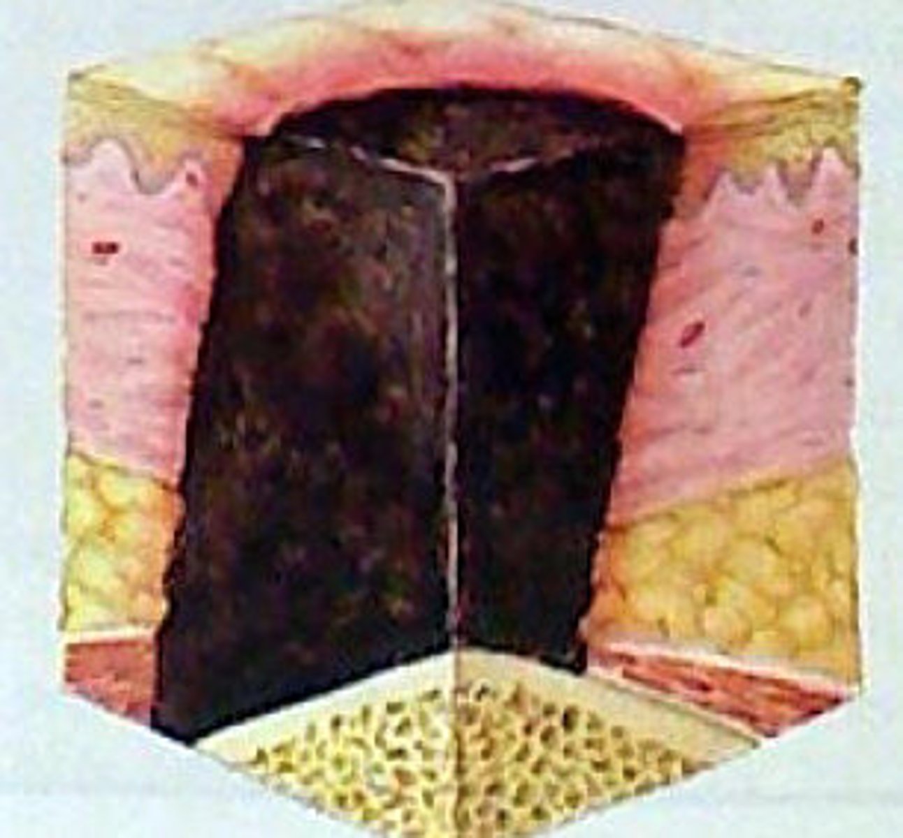 <p>full thickness skin and tissue loss</p><p>-extent of tissue damage within the ulcer cannot be confirmed because it is obscured by slough or eschar</p>