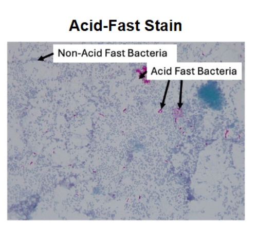 <p>In an Acid-Fast Stain, what color do <strong><mark data-color="#70c6f5" style="background-color: rgb(112, 198, 245); color: inherit;">Non-Acid-Fast Bacteria</mark></strong> appear, and why?</p>