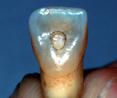 <p>This bur is used to cut the cavo-surface outline</p>