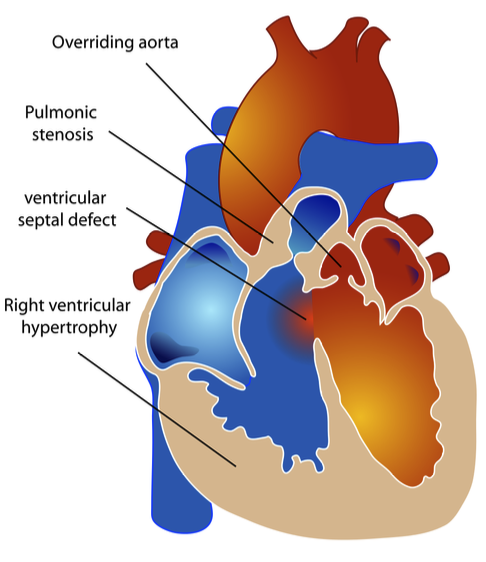 <p>4 defects: </p><ul><li><p>Large VSD</p></li><li><p>Overriding aorta that straddles VSD</p></li><li><p>Pulmonary stenosis </p></li><li><p>RV hypertrophy</p></li></ul><p></p>