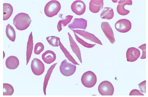 <p>Bent shape RBCs</p>