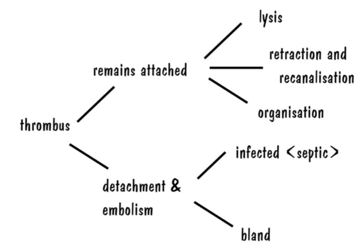 <p><strong>Occluding Thrombus</strong></p><p><u>Definition:</u> Blood clot fills the entire blood vessels which cannot lyse or recanalise </p><p><u>Sequelae:</u> Leads to ischaemia and infarction</p><p></p><p><strong>Non-Occluding Thrombus</strong></p><p><u>Definition:</u> Partially fills blood vessel</p><p><u>Sequelae:</u></p><ol><li><p>Lysis = Lysed in SMALL blood vessels by plasminogen-plasmid system </p><ul><li><p>Causes little damage to surrounding tissue</p></li></ul></li><li><p>Retraction and recanalisation = Multiple canals form within the thrombus which is lined with endothelial cells (edge of the thrombus AND canals) for blood to flow to distal tissues</p></li><li><p>Organisation = Occluding thrombus in larger vessel shrinks over time and is lined with endothelial cells to allow passage of blood through</p></li><li><p>Thromboembolism = Blood flows over the thrombus which dislodges part of it to become an embolus</p></li></ol><p></p>
