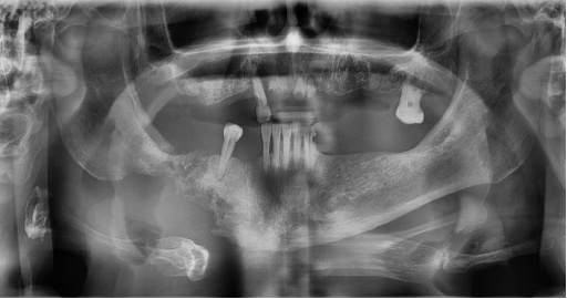 <p>CASE: A panoramic radiograph shows a destructive intrabony jaw lesion. Biopsy demonstrates squamous cell carcinoma, with the dominant disease process centered within bone rather than presenting primarily as a surface mucosal lesion. What lecture entity does this represent?</p>