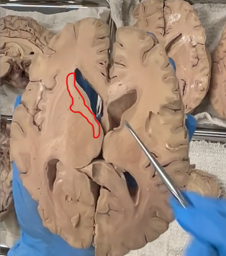 <p>posterior and lateral to the caudate nucleus is the internal capsule.</p><p><strong>Internal Capsule — Etymology &amp; Definition</strong> </p><p> <strong>Etymology</strong> </p><ul><li><p><strong>Latin roots:</strong></p><ul><li><p><strong><em>internus</em></strong> = “within”</p></li><li><p><strong><em>capsula</em></strong> = “little box” or “container”</p></li></ul></li></ul><p><span data-name="point_right" data-type="emoji">👉</span> So, <strong><em>internal capsule</em> literally means “inner container.”</strong><br>(Think of it as a <strong>bundle of fibers enclosed deep within the brain</strong>.)</p><p><strong>Definition (Neuroanatomy)</strong> </p><ul><li><p>The <strong>internal capsule</strong> is:</p><ul><li><p>A <strong>dense bundle of projection fibers</strong></p></li><li><p>Located deep within the cerebral hemispheres</p></li><li><p><strong>white matter</strong> that carries information <strong>to and from the cerebral cortex</strong></p></li></ul></li></ul><p></p>
