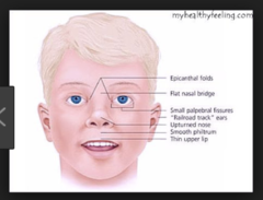 <p>- Severe intellectual disability (cognitive, speech, motor delays)</p><p>- Infants cry like cat</p><p>- Microcephaly, wide set eyes, low ears, small jaw</p><p>- Congenital HD</p>
