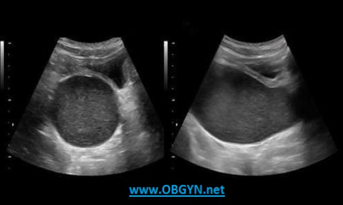 <p>A 12yr old presents with pelvic pain and bloating. She states she has not yet had her first menstrual cycle. The ultrasound findings are most suggestive of:</p><p>A. endometriosis</p><p>B. endometrial hyperplasia</p><p>C. hematometrocolpos</p><p>D. thecoma</p>