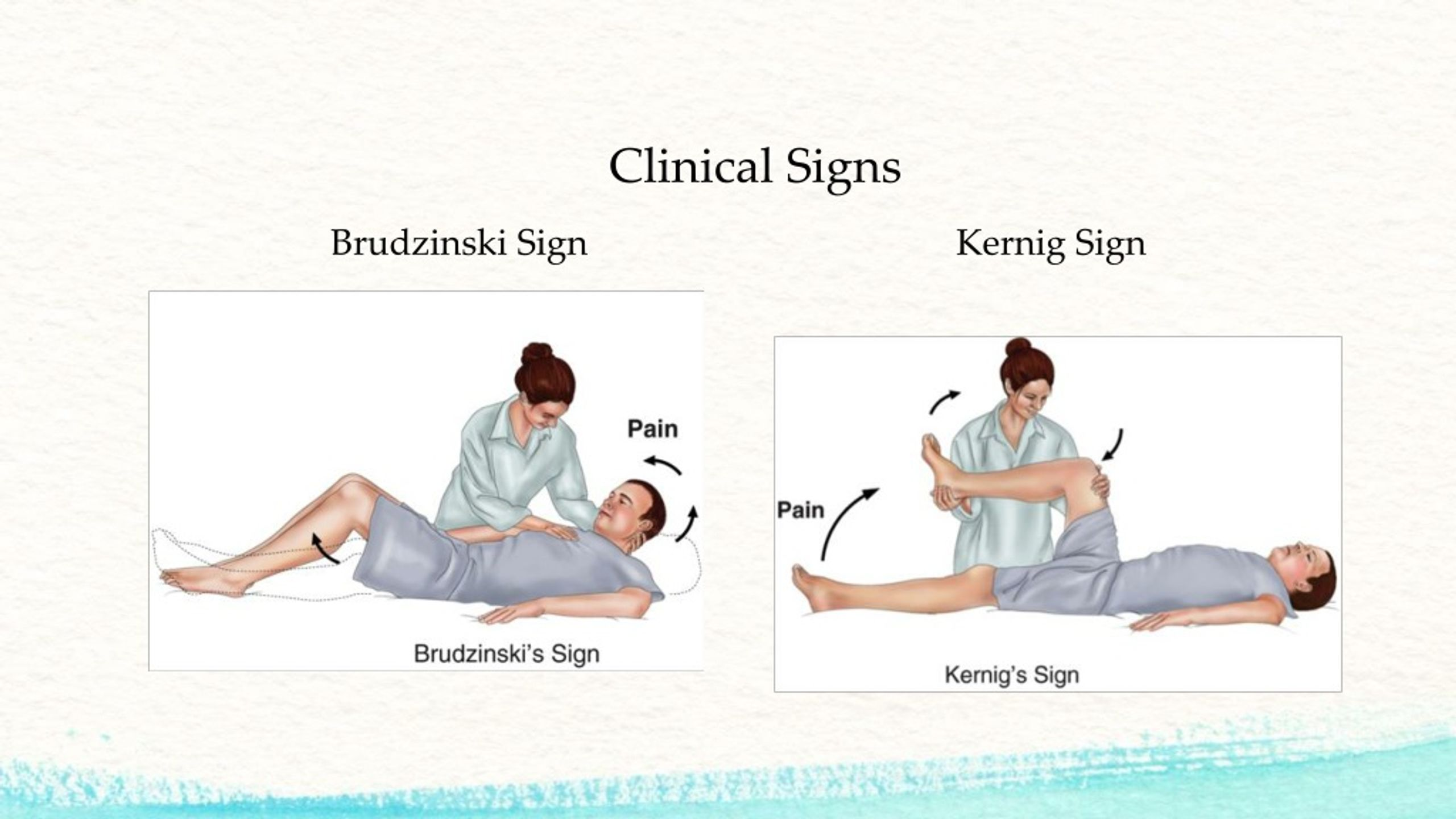 <p><span style="color: rgb(138, 103, 238);"><strong>Brudzinski’s </strong></span></p><ul><li><p><span style="color: rgb(12, 11, 16);">A sign o</span><span style="color: rgb(138, 103, 238);">f <strong>meningitis</strong> </span><span style="color: rgb(21, 20, 23);">where </span><span style="color: rgb(138, 103, 238);"><strong>the hips and knees automatically bend when neck is bent forward.</strong></span></p></li></ul><p></p><p><span style="color: rgb(90, 152, 20);"><strong>Kernig’s </strong></span></p><ul><li><p><span style="color: rgb(18, 23, 11);">the </span><span style="color: rgb(90, 152, 20);"><strong>leg cant fully straighten b/c of pain and resistance.</strong></span></p><p></p></li></ul><p></p>