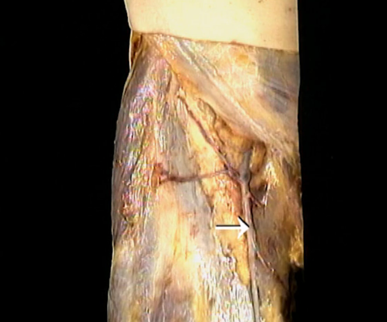 <p>Oppervlakkig, mediaal knie</p>