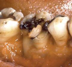 <p>Why is CLP contraindicated?</p>