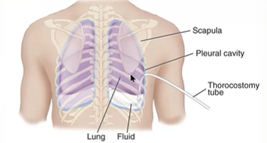 <p>what does this alleviate </p>