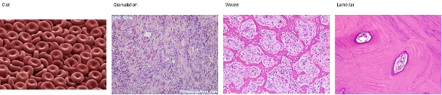 <p>CASE: After an extraction, normal socket healing is disrupted because necrotic tissue prevents formation of healthy granulation tissue. Put the normal healing sequence in order and explain why necrosis interferes with closure.</p>