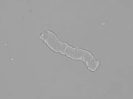 <p>- Highly refractile readily visible</p><p>- well defined edges, sharp, blunt, uneven ends</p><p>- cracks or fissures from lateral margins</p><p>Prolonged stasis and tubular obstruction</p>