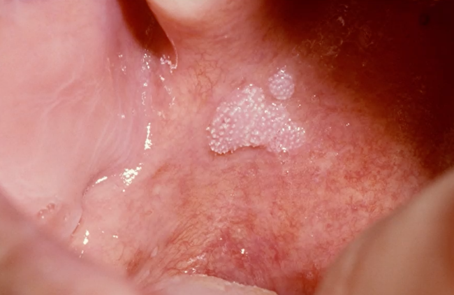 <p>23 y/o woman present with PAINLESS, soft pink, cauliflower loke mass on soft palate. which is NOT in the DDx: </p><p>squamous papilloma </p><p>neurfibroma </p><p>condyloma acuminatum </p><p>verruca vulgaris </p>