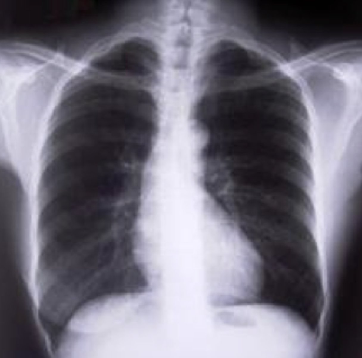 <p>-progressive destruction of the alveoli in the lungs; trouble expelling air</p><p>-x-rays show increased lung dimension, very radiolucent (dark), depressed diaphragm, and elongated heart shadow</p>