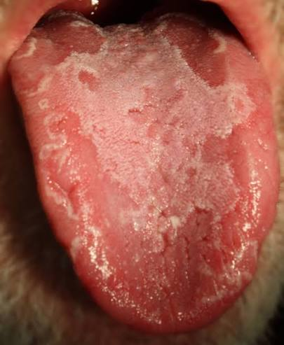<ul><li><p>Denuded filiform papilla </p></li><li><p>if on gingiva- erythema migrans </p></li></ul><p></p>