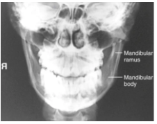 <p><span style="background-color: transparent;">Mandible PA for body</span></p>