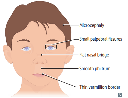 Developmental delay<br>Microcephaly<br>Characteristic facial abnormalities<br>± Limb dislocation<br>± Heart defects