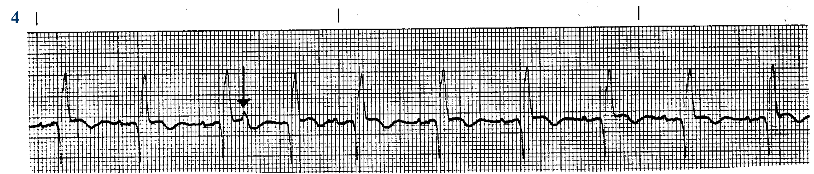<p>What ECG? </p>
