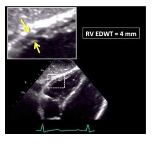 <p>Wall thickness is obtained from the Subcostal view at end diastole. </p><p>Zoom on mid RV wall </p><p>A thickness of >5mm is abnormal</p><p> <5mmis normal</p>