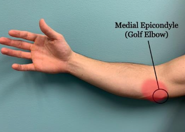 <p>Medial Epicondylitiis (golfer elbow)</p>