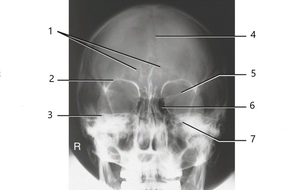 <p>Which sinuses are best demonstrated by the following image?</p>