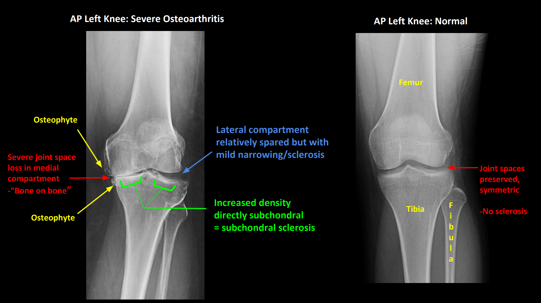 <p>XR: First-line</p><p>4 cardinal signs (LOSS)</p><ol><li><p>Loss of joint space</p></li></ol><ul><li><p>Irregular</p></li></ul><ol start="2"><li><p>Osteophytes</p></li></ol><ul><li><p>Spurs/densification on joint edge</p></li></ul><ol start="3"><li><p>Subchondral cysts</p></li></ol><ul><li><p>Fluid-filled cyst on joint surface (from joint stress)</p></li></ul><ol start="4"><li><p>Subchondral sclerosis</p></li></ol><ul><li><p>Increased bone density below joint cartilage</p></li></ul><p></p>