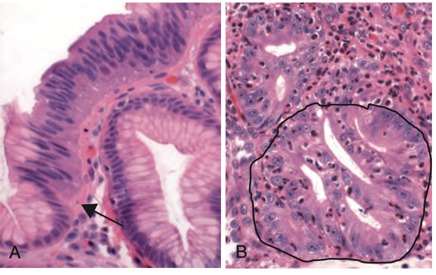 <p>dysplasia seen in </p>