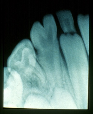 <p>2 crowns from one tooth bud</p><p></p><p>1 root, 2 crowns</p>