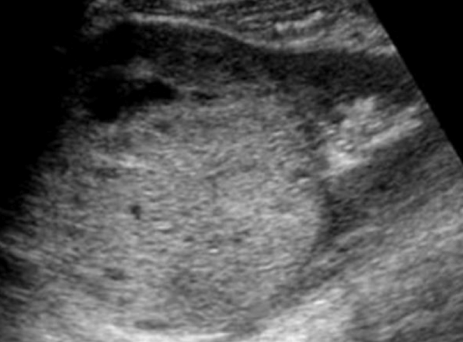 <ul><li><p>large, well circumscribed</p></li><li><p>homogenous</p></li><li><p>anechoic/cystic spaces </p></li><li><p>can invade LNs, renal veins, IVC </p></li></ul><p></p>