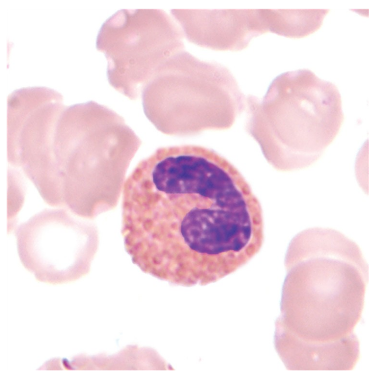 <p>what is an eosinophilic band?</p>
