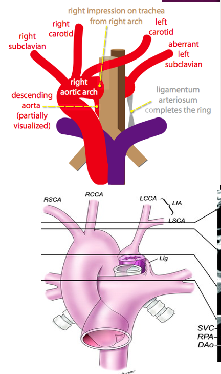 <p>mirror image type (most common) </p><ul><li><p>lt innominate</p></li><li><p>RCCA</p></li><li><p>RSCA </p></li></ul><p>right ao arch with aberrant LSA</p><p>right ao arch with isolation of left subclavian artery </p><p></p>