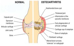 <p>degenerative joint disease</p>