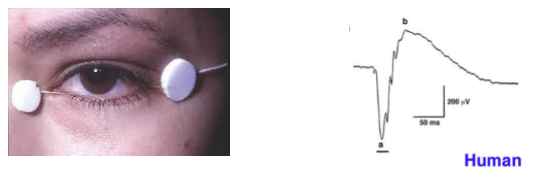 <p>An ERG measures the summed electrical activity of the retina in response to light stimuli.<br>Recorded using a corneal or periocular electrode: historically a contact‑lens electrode with speculum; now commonly a thin wire along the lower eyelid connected to an amplifier.</p>